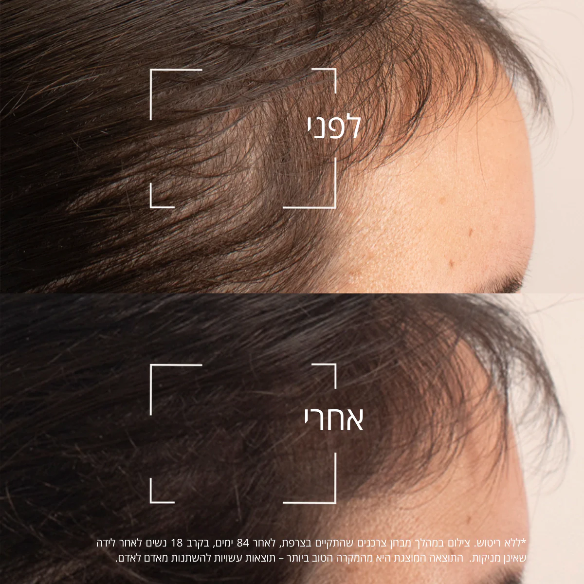 סרום למניעת נשירת שיער - Image 3