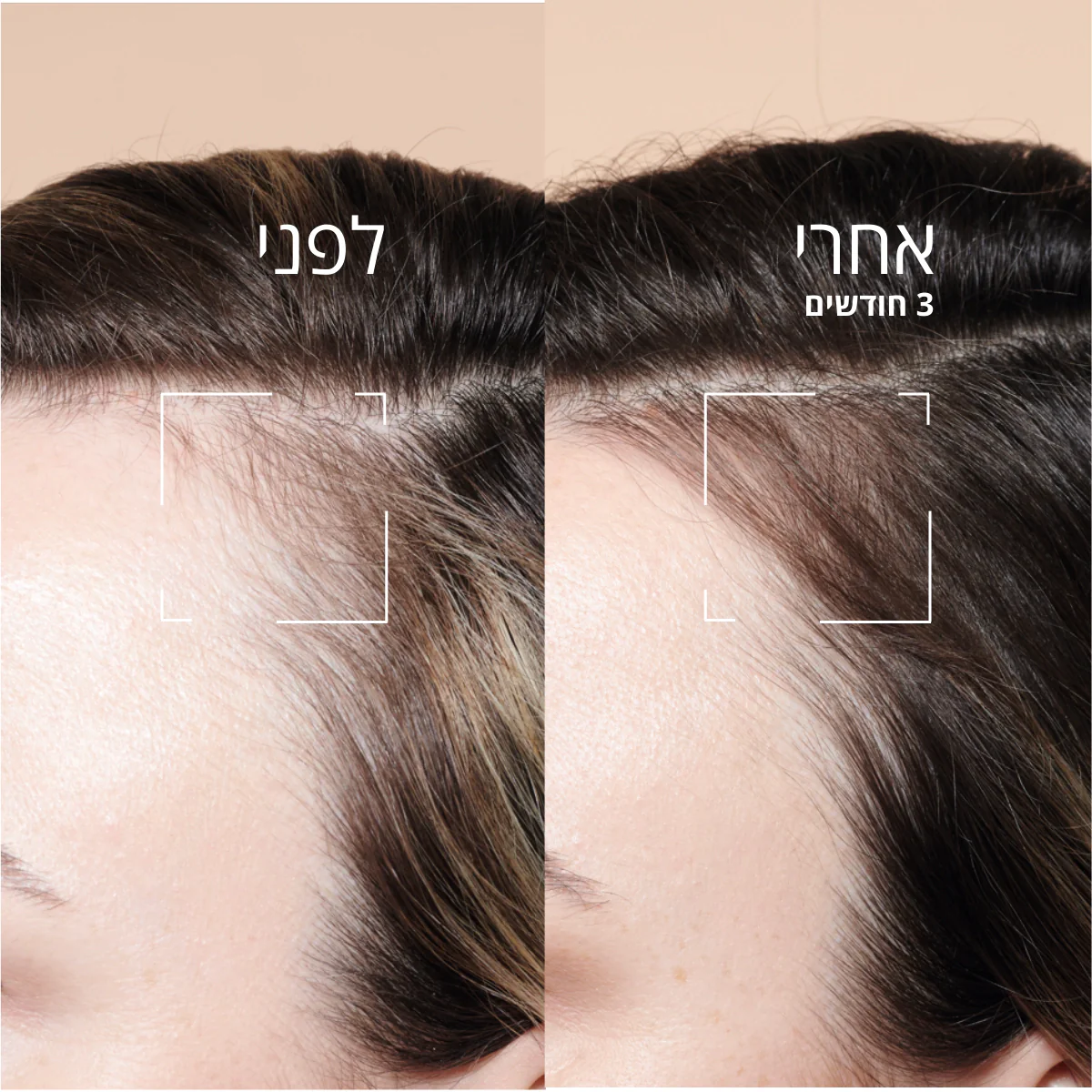 סרום למניעת נשירת שיער - Image 4